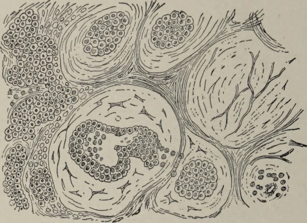 An illustration from A text-book of pathology / by Alfred Stengel ; with 394 illustrations in the text, many of them in colors, and 7 full-page chromolithographic plates., 1903, leaf 194