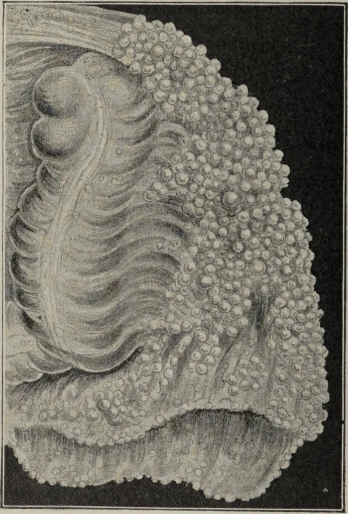 An illustration from A text-book of pathology / by Alfred Stengel ; with 394 illustrations in the text, many of them in colors, and 7 full-page chromolithographic plates., 1903, leaf 194