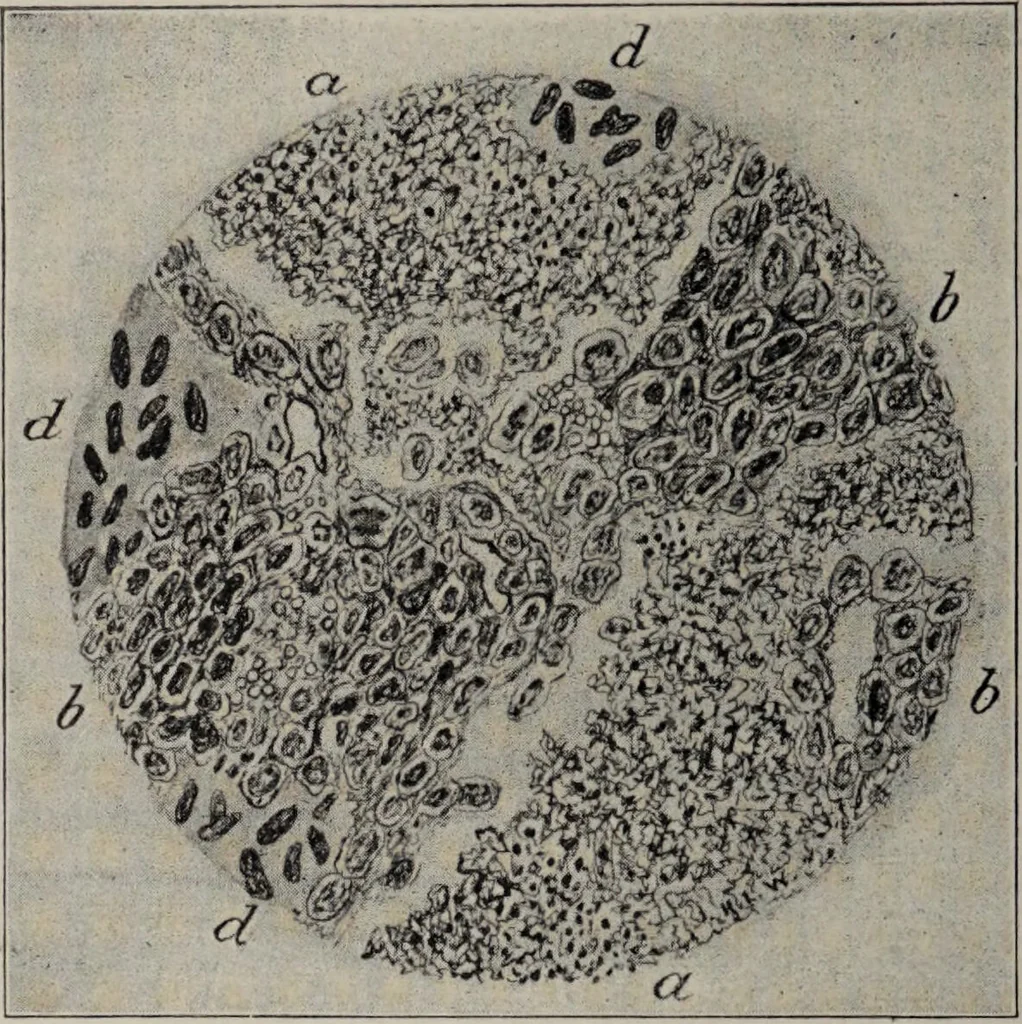 An illustration from A text-book of pathology / by Alfred Stengel ; with 394 illustrations in the text, many of them in colors, and 7 full-page chromolithographic plates., 1903, leaf 196
