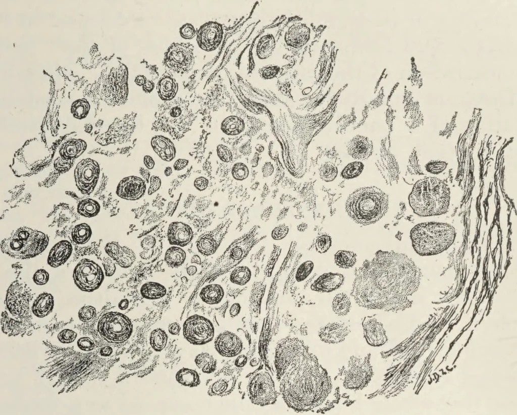 An illustration from A text-book of pathology / by Alfred Stengel ; with 394 illustrations in the text, many of them in colors, and 7 full-page chromolithographic plates., 1903, leaf 201
