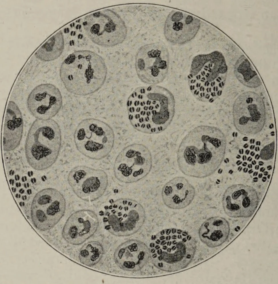 An illustration from A text-book of pathology / by Alfred Stengel ; with 394 illustrations in the text, many of them in colors, and 7 full-page chromolithographic plates., 1903, leaf 230