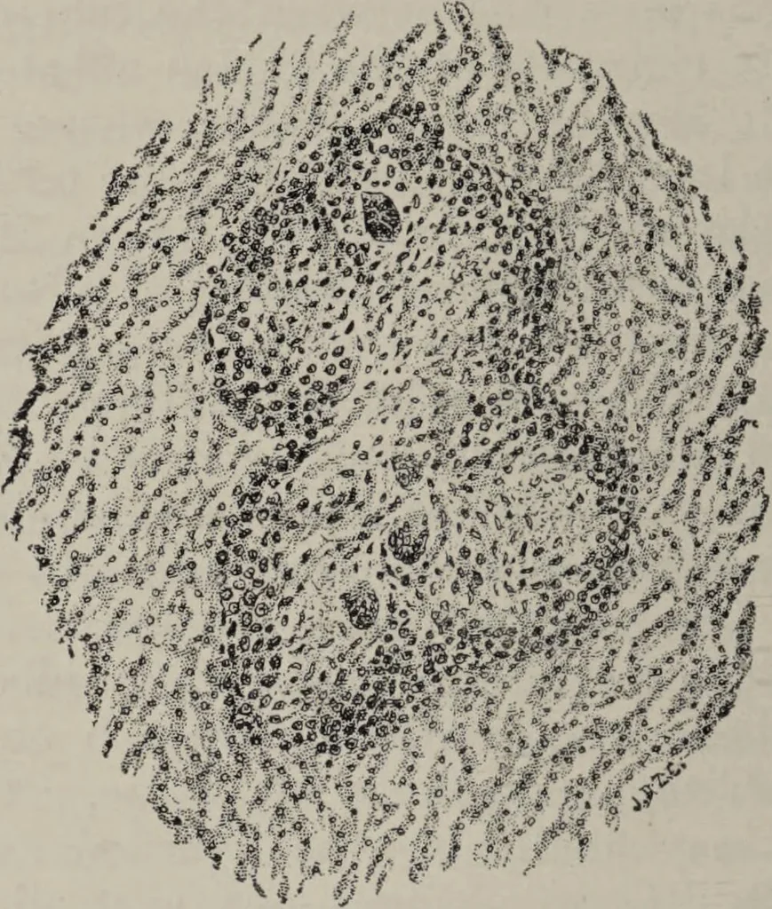 An illustration from A text-book of pathology / by Alfred Stengel ; with 394 illustrations in the text, many of them in colors, and 7 full-page chromolithographic plates., 1903, leaf 256