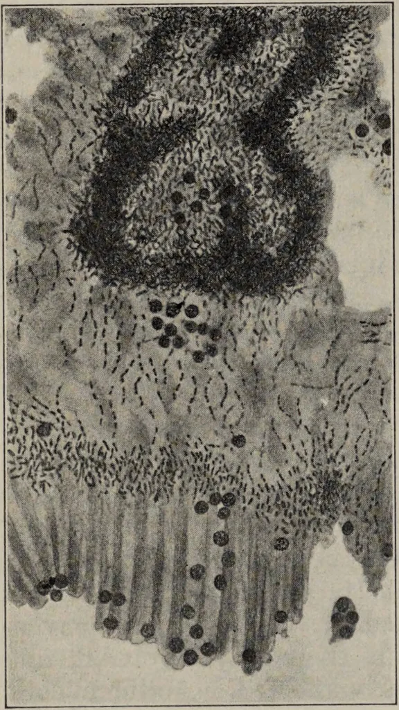 An illustration from A text-book of pathology / by Alfred Stengel ; with 394 illustrations in the text, many of them in colors, and 7 full-page chromolithographic plates., 1903, leaf 282