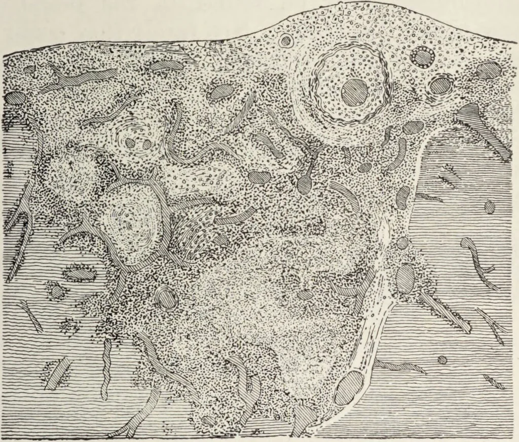 An illustration from A text-book of pathology / by Alfred Stengel ; with 394 illustrations in the text, many of them in colors, and 7 full-page chromolithographic plates., 1903, leaf 291