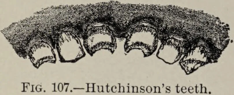 An illustration from A text-book of pathology / by Alfred Stengel ; with 394 illustrations in the text, many of them in colors, and 7 full-page chromolithographic plates., 1903, leaf 292