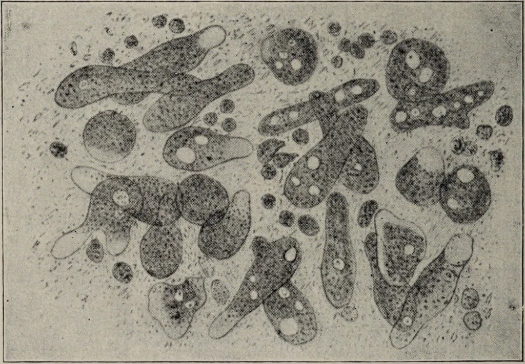 An illustration from A text-book of pathology / by Alfred Stengel ; with 394 illustrations in the text, many of them in colors, and 7 full-page chromolithographic plates., 1903, leaf 302