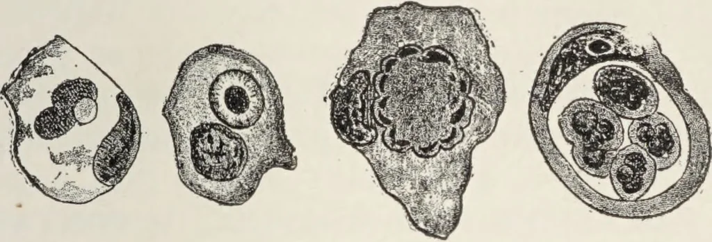 An illustration from A text-book of pathology / by Alfred Stengel ; with 394 illustrations in the text, many of them in colors, and 7 full-page chromolithographic plates., 1903, leaf 315