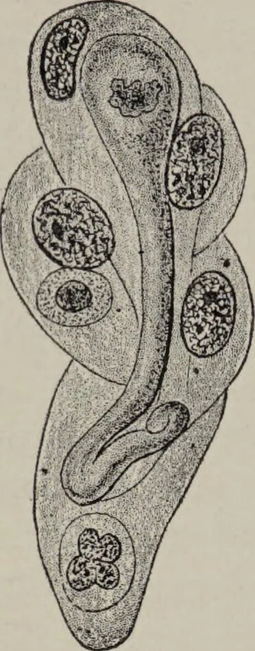 An illustration from A text-book of pathology / by Alfred Stengel ; with 394 illustrations in the text, many of them in colors, and 7 full-page chromolithographic plates., 1903, leaf 316