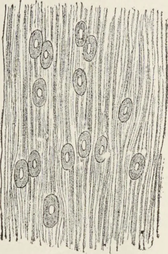 An illustration from A text-book of pathology / by Alfred Stengel ; with 394 illustrations in the text, many of them in colors, and 7 full-page chromolithographic plates., 1903, leaf 321