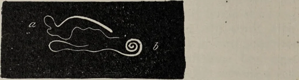 An illustration from A text-book of pathology / by Alfred Stengel ; with 394 illustrations in the text, many of them in colors, and 7 full-page chromolithographic plates., 1903, leaf 332