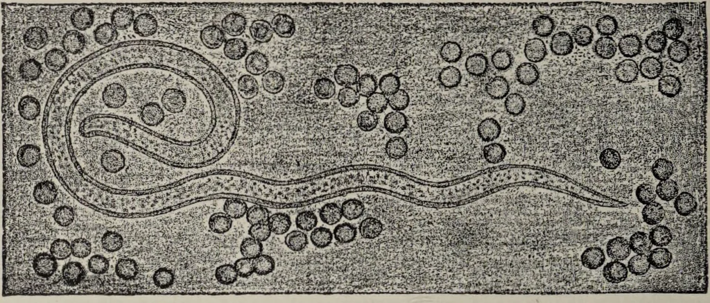 An illustration from A text-book of pathology / by Alfred Stengel ; with 394 illustrations in the text, many of them in colors, and 7 full-page chromolithographic plates., 1903, leaf 334