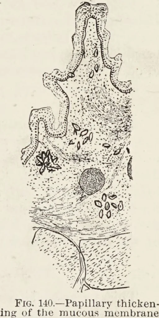 An illustration from A text-book of pathology / by Alfred Stengel ; with 394 illustrations in the text, many of them in colors, and 7 full-page chromolithographic plates., 1903, leaf 337
