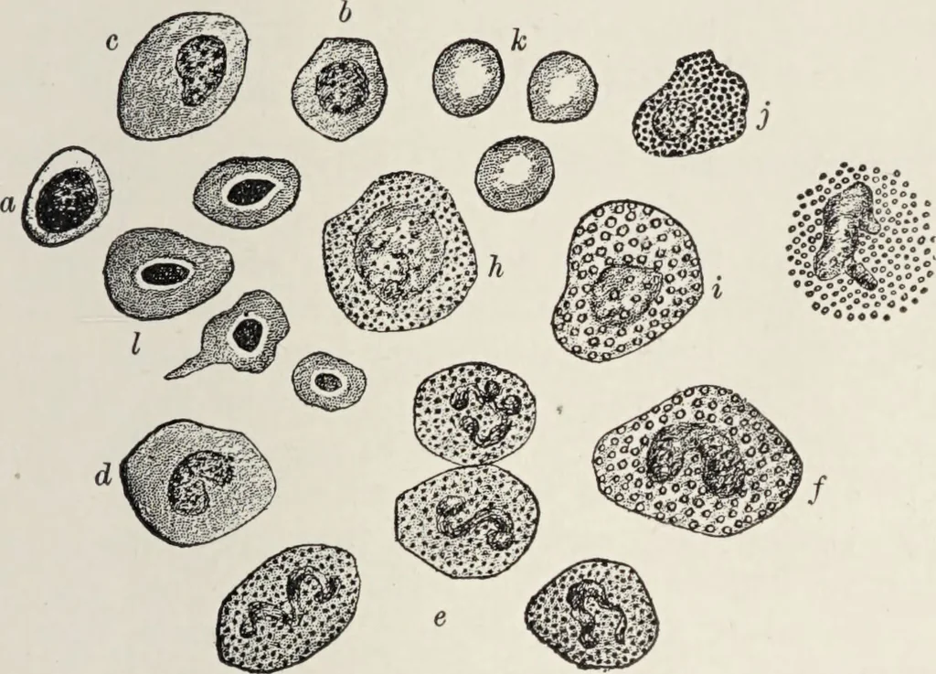 An illustration from A text-book of pathology / by Alfred Stengel ; with 394 illustrations in the text, many of them in colors, and 7 full-page chromolithographic plates., 1903, leaf 341