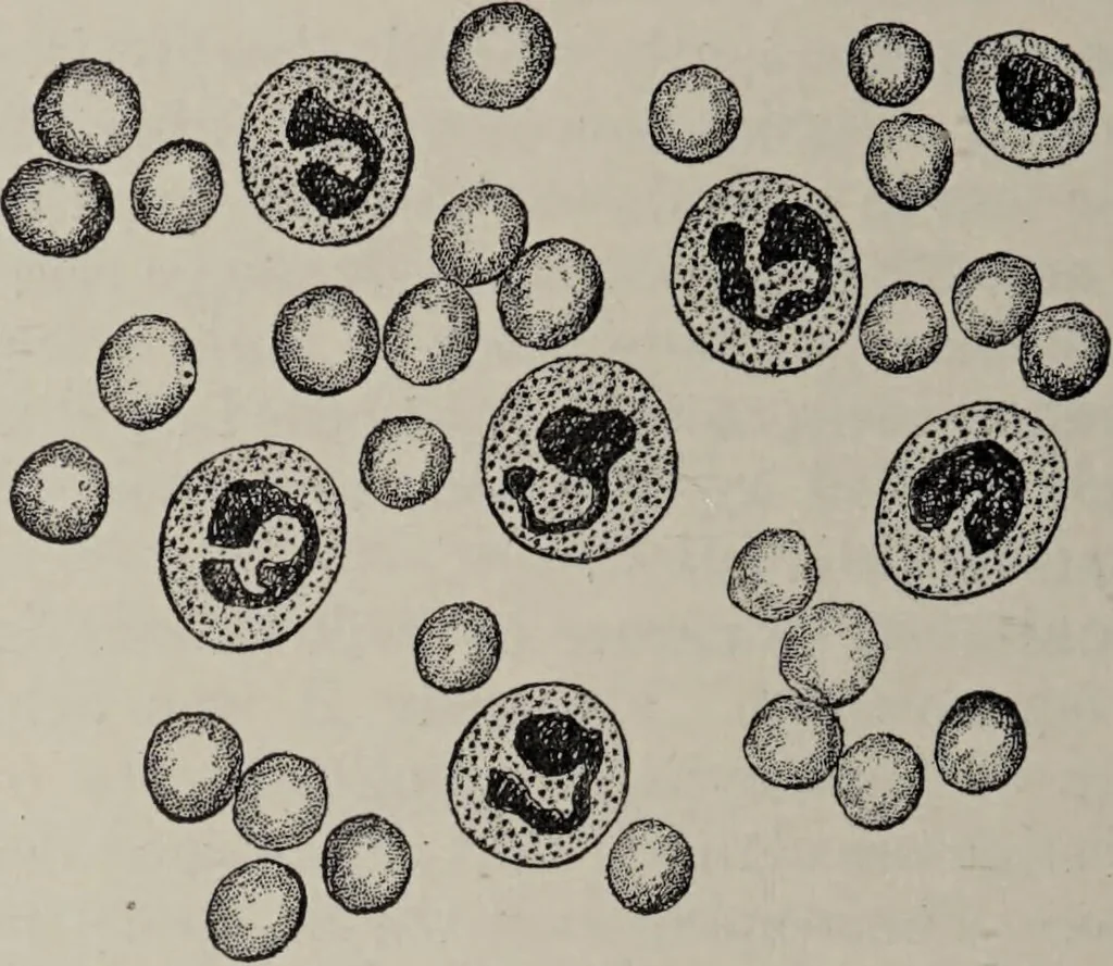 An illustration from A text-book of pathology / by Alfred Stengel ; with 394 illustrations in the text, many of them in colors, and 7 full-page chromolithographic plates., 1903, leaf 356