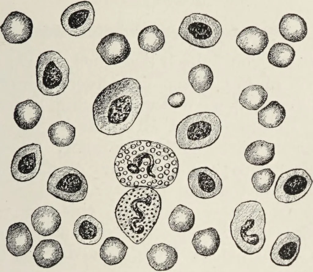 An illustration from A text-book of pathology / by Alfred Stengel ; with 394 illustrations in the text, many of them in colors, and 7 full-page chromolithographic plates., 1903, leaf 367