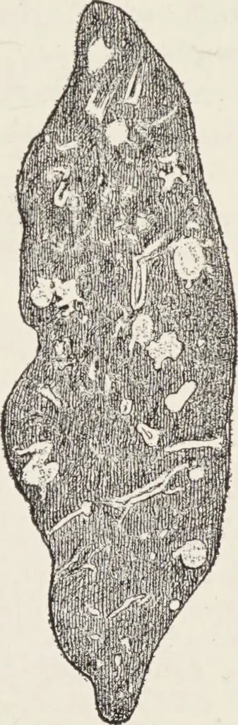 An illustration from A text-book of pathology / by Alfred Stengel ; with 394 illustrations in the text, many of them in colors, and 7 full-page chromolithographic plates., 1903, leaf 377