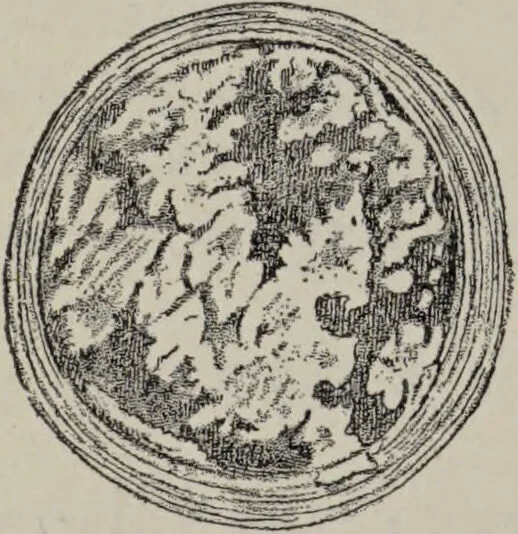 An illustration from A text-book of pathology / by Alfred Stengel ; with 394 illustrations in the text, many of them in colors, and 7 full-page chromolithographic plates., 1903, leaf 382