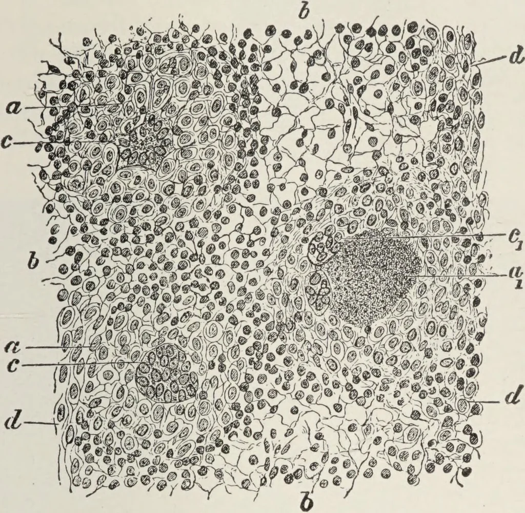 An illustration from A text-book of pathology / by Alfred Stengel ; with 394 illustrations in the text, many of them in colors, and 7 full-page chromolithographic plates., 1903, leaf 383