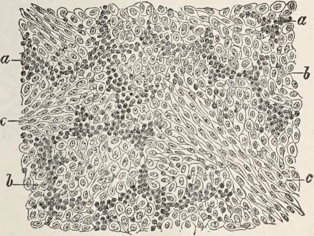 An illustration from A text-book of pathology / by Alfred Stengel ; with 394 illustrations in the text, many of them in colors, and 7 full-page chromolithographic plates., 1903, leaf 383