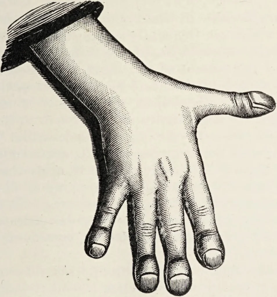 An illustration from A text-book of pathology / by Alfred Stengel ; with 394 illustrations in the text, many of them in colors, and 7 full-page chromolithographic plates., 1903, leaf 395