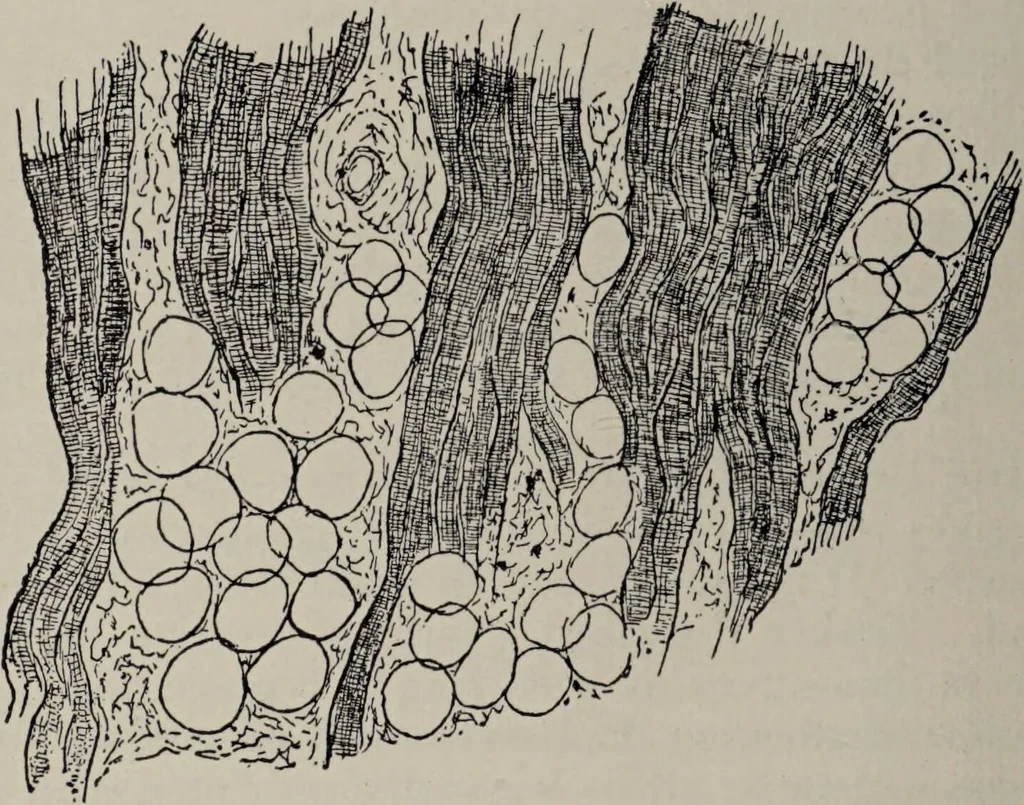 An illustration from A text-book of pathology / by Alfred Stengel ; with 394 illustrations in the text, many of them in colors, and 7 full-page chromolithographic plates., 1903, leaf 408