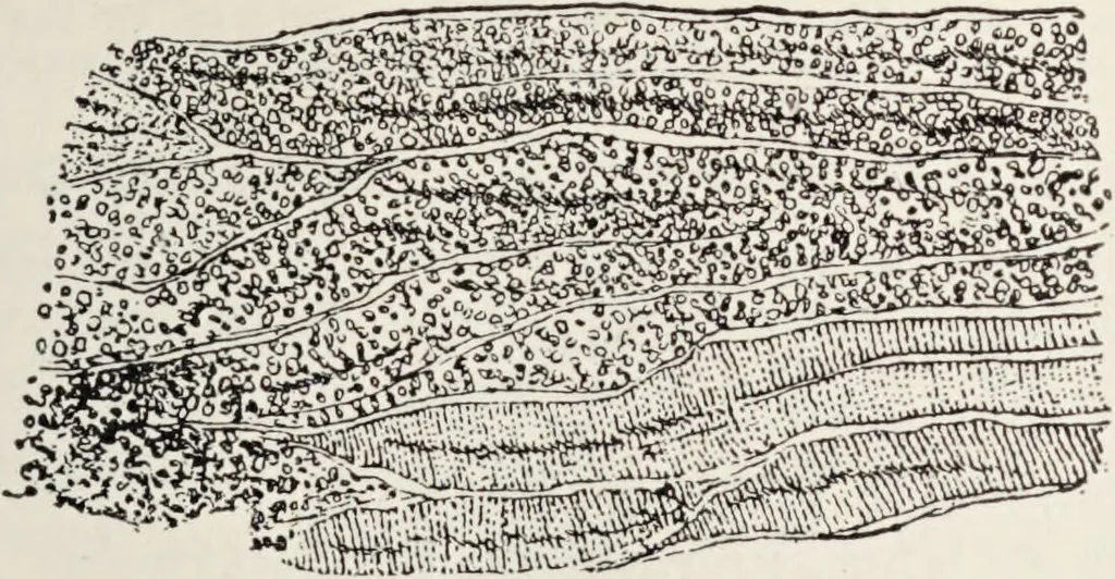 An illustration from A text-book of pathology / by Alfred Stengel ; with 394 illustrations in the text, many of them in colors, and 7 full-page chromolithographic plates., 1903, leaf 409