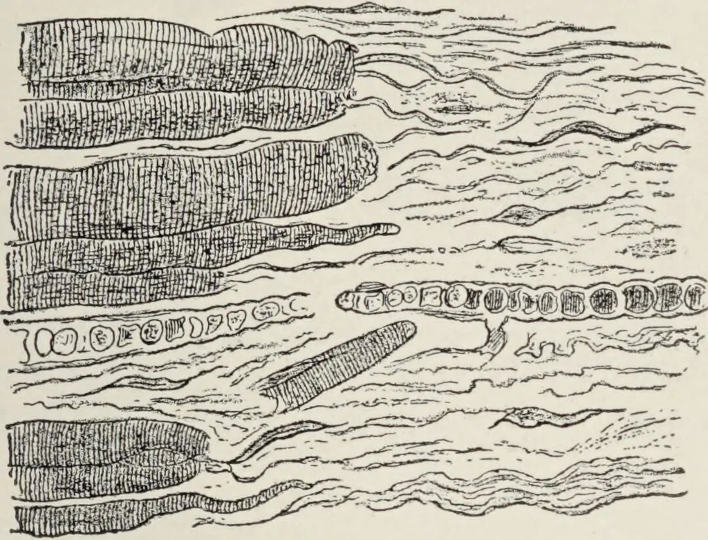 An illustration from A text-book of pathology / by Alfred Stengel ; with 394 illustrations in the text, many of them in colors, and 7 full-page chromolithographic plates., 1903, leaf 415