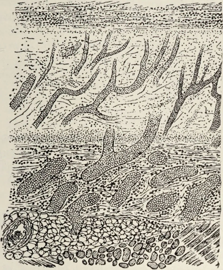 An illustration from A text-book of pathology / by Alfred Stengel ; with 394 illustrations in the text, many of them in colors, and 7 full-page chromolithographic plates., 1903, leaf 427