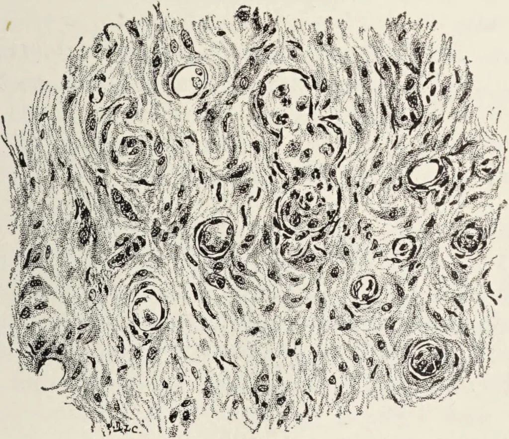 An illustration from A text-book of pathology / by Alfred Stengel ; with 394 illustrations in the text, many of them in colors, and 7 full-page chromolithographic plates., 1903, leaf 427