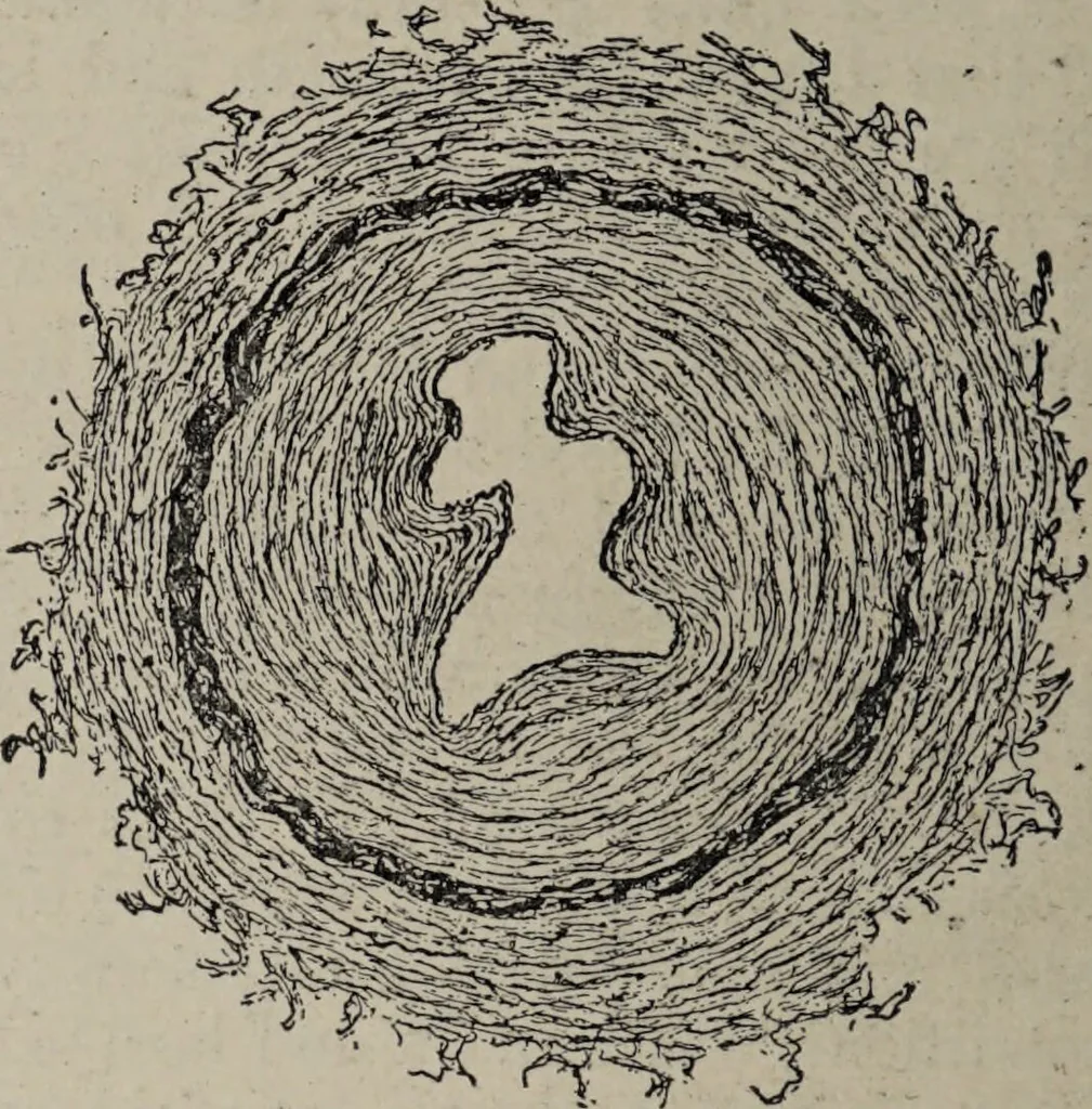 An illustration from A text-book of pathology / by Alfred Stengel ; with 394 illustrations in the text, many of them in colors, and 7 full-page chromolithographic plates., 1903, leaf 434