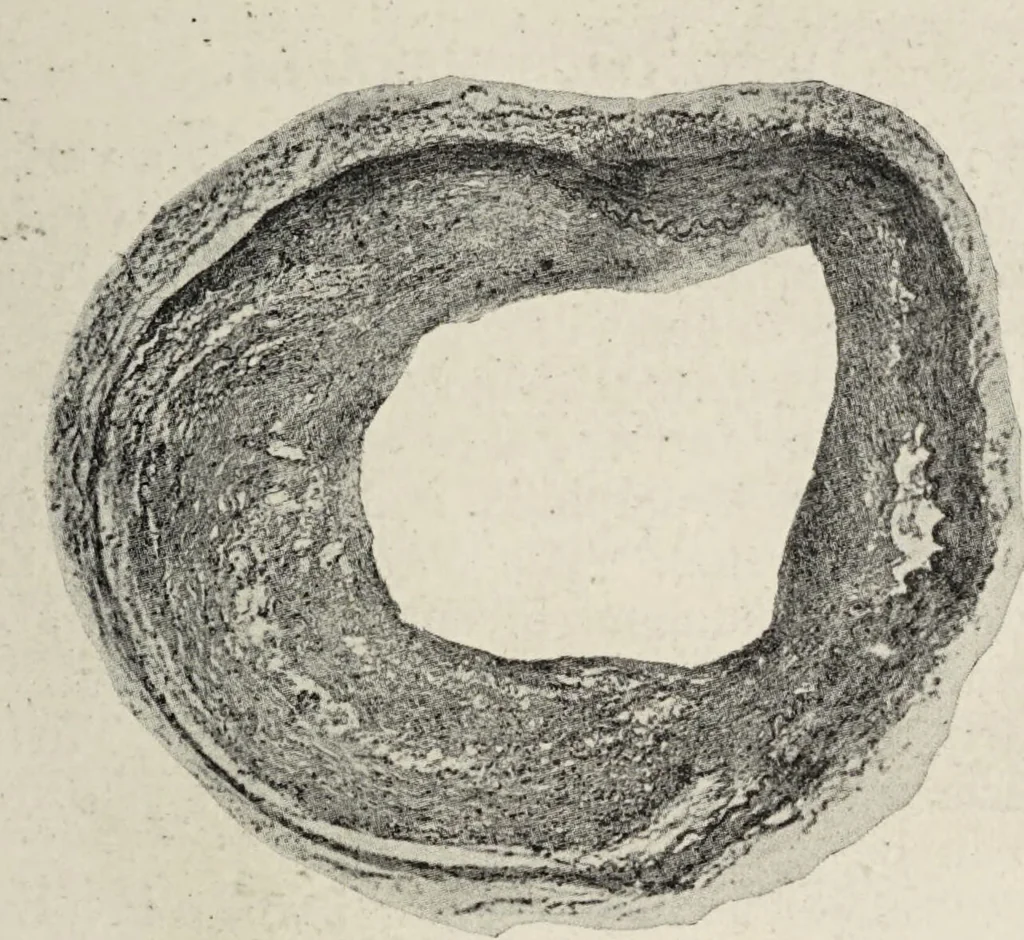 An illustration from A text-book of pathology / by Alfred Stengel ; with 394 illustrations in the text, many of them in colors, and 7 full-page chromolithographic plates., 1903, leaf 435