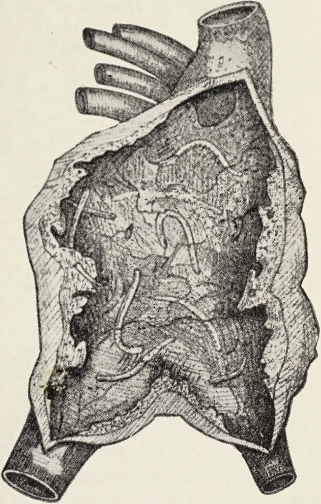 An illustration from A text-book of pathology / by Alfred Stengel ; with 394 illustrations in the text, many of them in colors, and 7 full-page chromolithographic plates., 1903, leaf 437