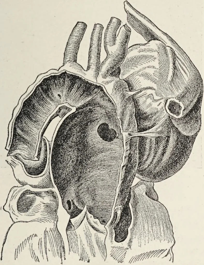 An illustration from A text-book of pathology / by Alfred Stengel ; with 394 illustrations in the text, many of them in colors, and 7 full-page chromolithographic plates., 1903, leaf 439