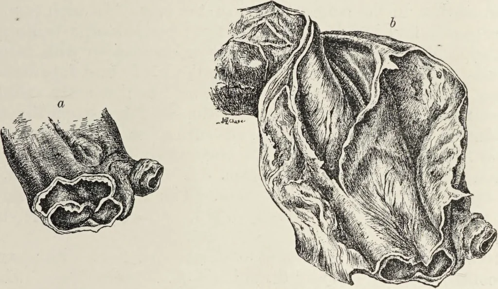 An illustration from A text-book of pathology / by Alfred Stengel ; with 394 illustrations in the text, many of them in colors, and 7 full-page chromolithographic plates., 1903, leaf 443