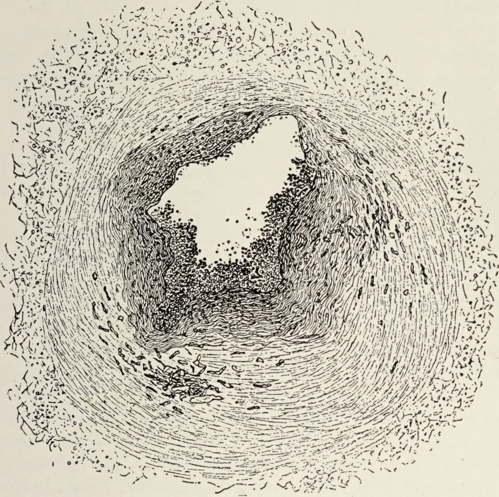 An illustration from A text-book of pathology / by Alfred Stengel ; with 394 illustrations in the text, many of them in colors, and 7 full-page chromolithographic plates., 1903, leaf 445