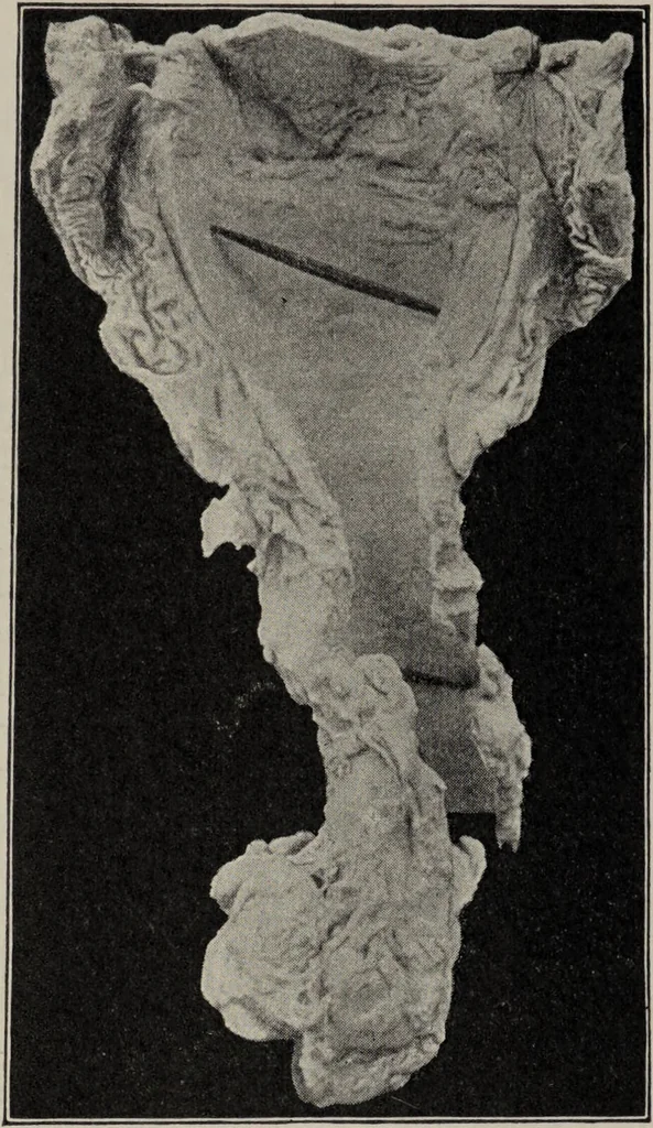 An illustration from A text-book of pathology / by Alfred Stengel ; with 394 illustrations in the text, many of them in colors, and 7 full-page chromolithographic plates., 1903, leaf 454