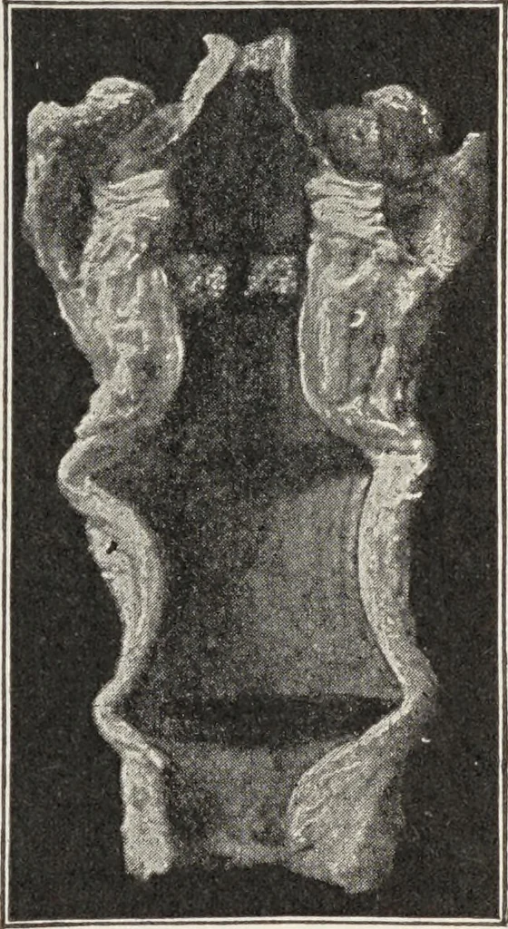 An illustration from A text-book of pathology / by Alfred Stengel ; with 394 illustrations in the text, many of them in colors, and 7 full-page chromolithographic plates., 1903, leaf 455