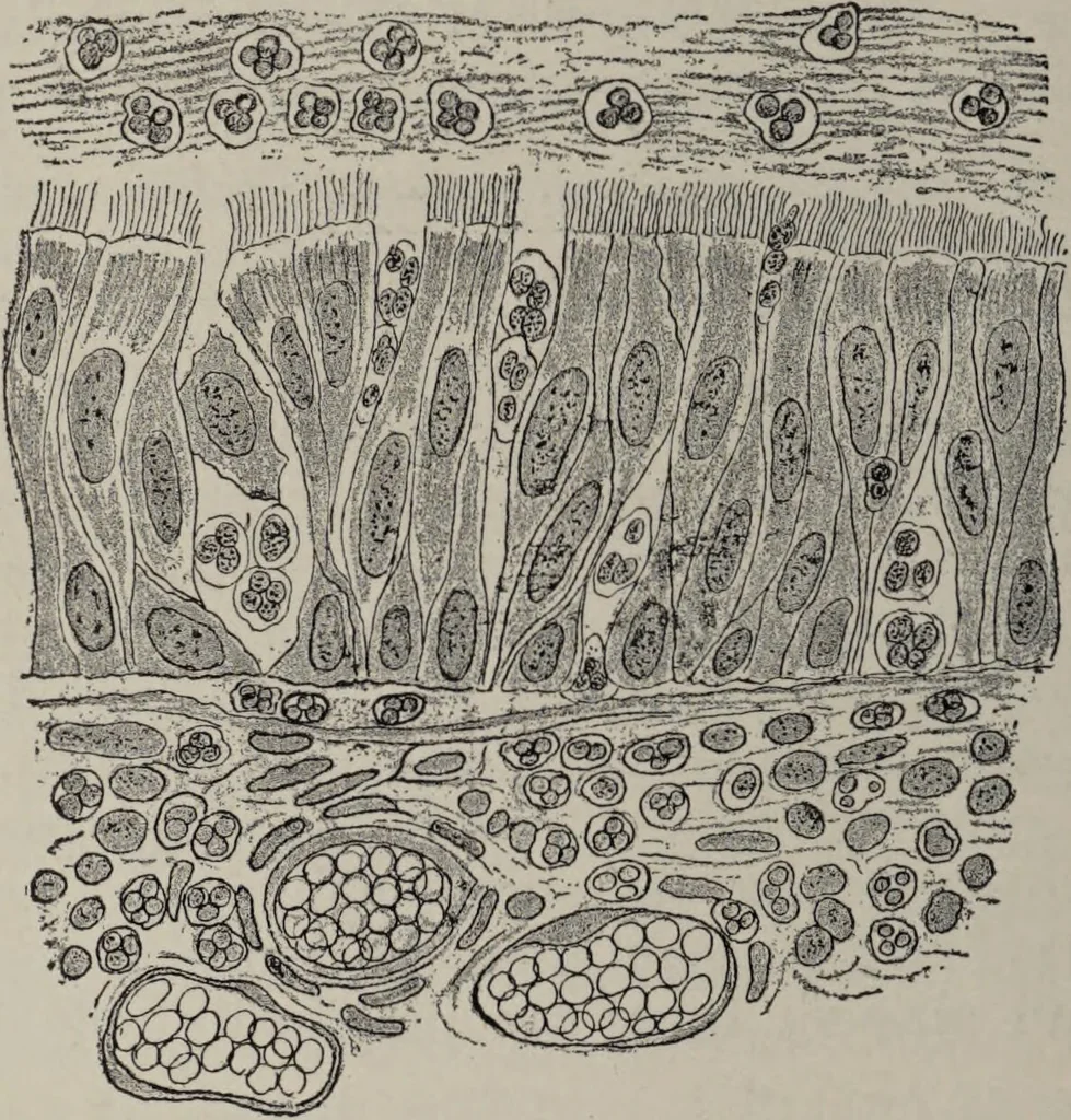An illustration from A text-book of pathology / by Alfred Stengel ; with 394 illustrations in the text, many of them in colors, and 7 full-page chromolithographic plates., 1903, leaf 458