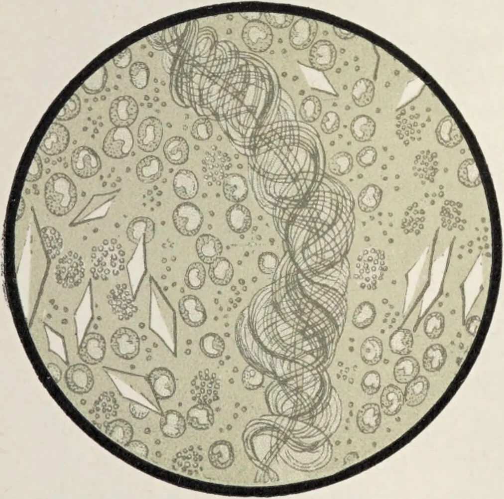 An illustration from A text-book of pathology / by Alfred Stengel ; with 394 illustrations in the text, many of them in colors, and 7 full-page chromolithographic plates., 1903, leaf 459