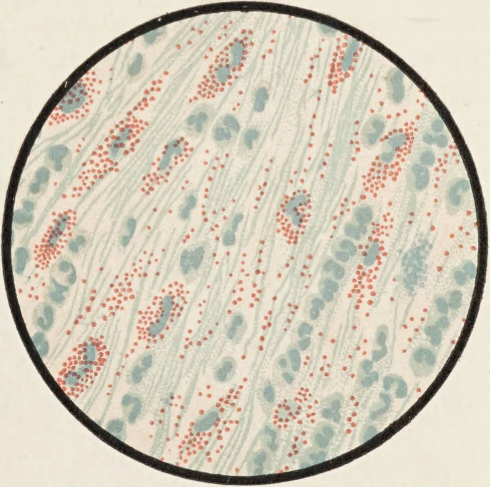 An illustration from A text-book of pathology / by Alfred Stengel ; with 394 illustrations in the text, many of them in colors, and 7 full-page chromolithographic plates., 1903, leaf 459