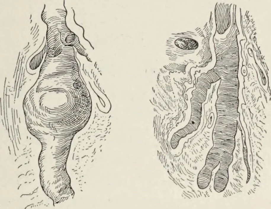 An illustration from A text-book of pathology / by Alfred Stengel ; with 394 illustrations in the text, many of them in colors, and 7 full-page chromolithographic plates., 1903, leaf 461