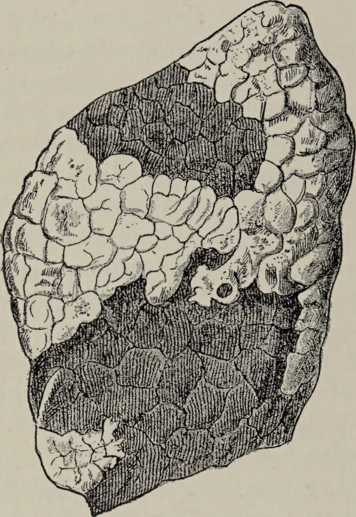 An illustration from A text-book of pathology / by Alfred Stengel ; with 394 illustrations in the text, many of them in colors, and 7 full-page chromolithographic plates., 1903, leaf 472