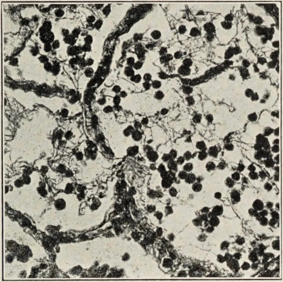 An illustration from A text-book of pathology / by Alfred Stengel ; with 394 illustrations in the text, many of them in colors, and 7 full-page chromolithographic plates., 1903, leaf 475