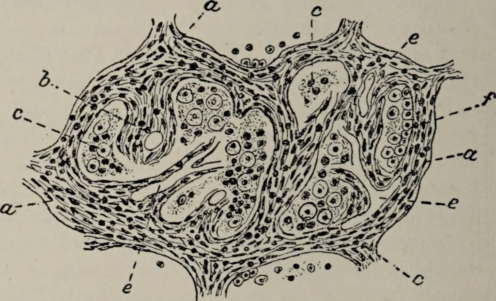 An illustration from A text-book of pathology / by Alfred Stengel ; with 394 illustrations in the text, many of them in colors, and 7 full-page chromolithographic plates., 1903, leaf 482