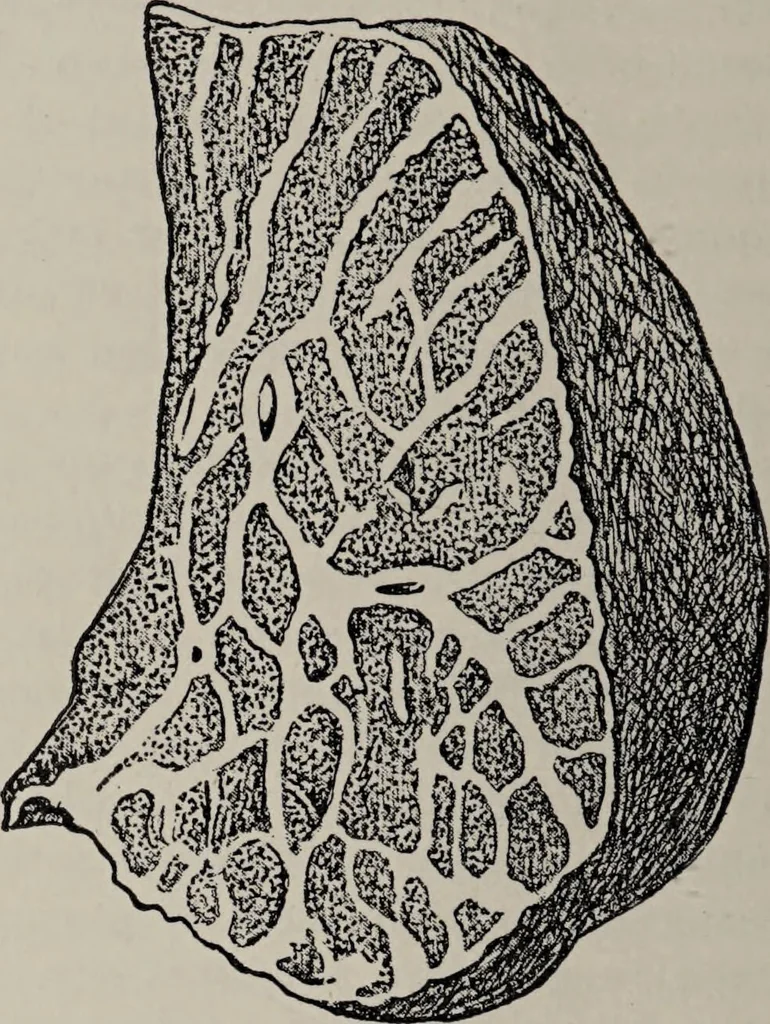 An illustration from A text-book of pathology / by Alfred Stengel ; with 394 illustrations in the text, many of them in colors, and 7 full-page chromolithographic plates., 1903, leaf 494