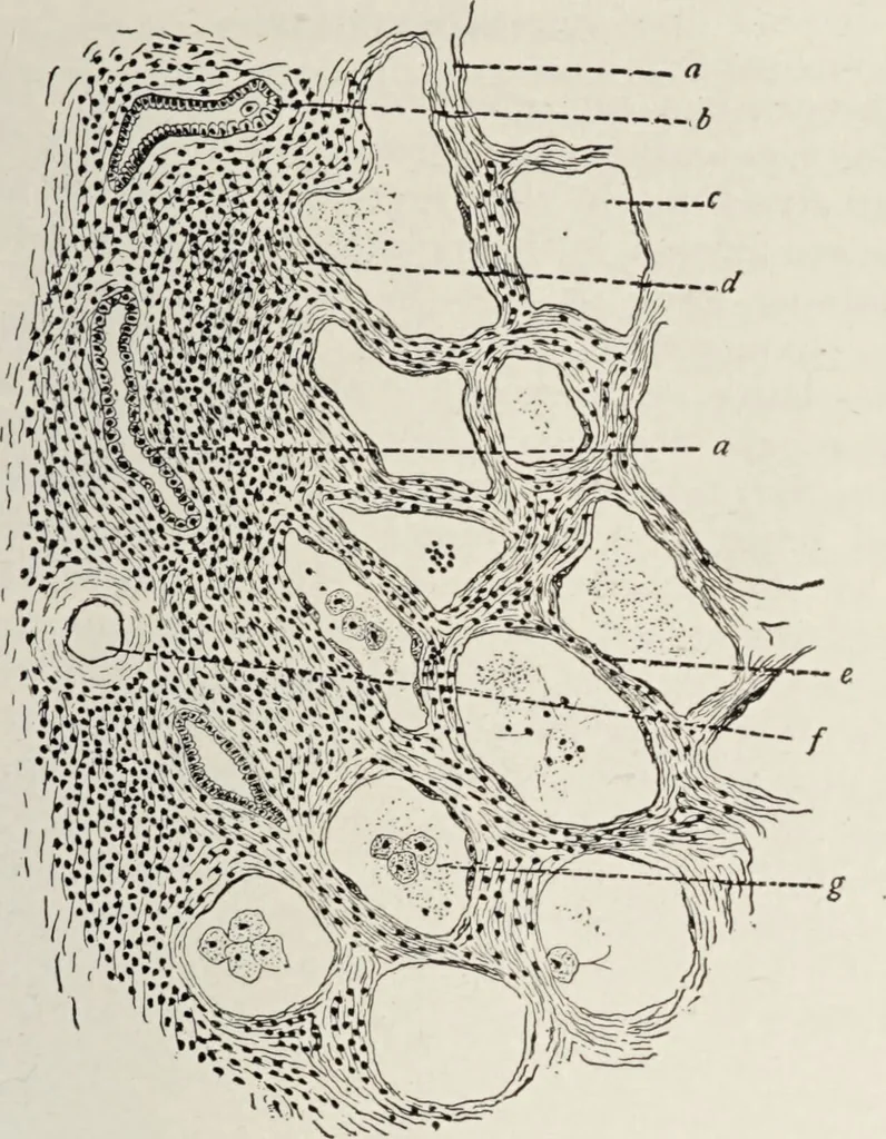 An illustration from A text-book of pathology / by Alfred Stengel ; with 394 illustrations in the text, many of them in colors, and 7 full-page chromolithographic plates., 1903, leaf 511
