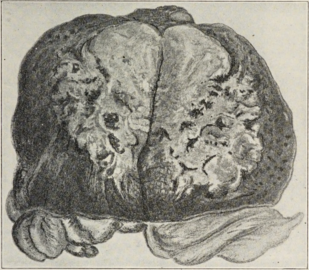 An illustration from A text-book of pathology / by Alfred Stengel ; with 394 illustrations in the text, many of them in colors, and 7 full-page chromolithographic plates., 1903, leaf 513