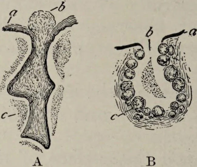 An illustration from A text-book of pathology / by Alfred Stengel ; with 394 illustrations in the text, many of them in colors, and 7 full-page chromolithographic plates., 1903, leaf 536