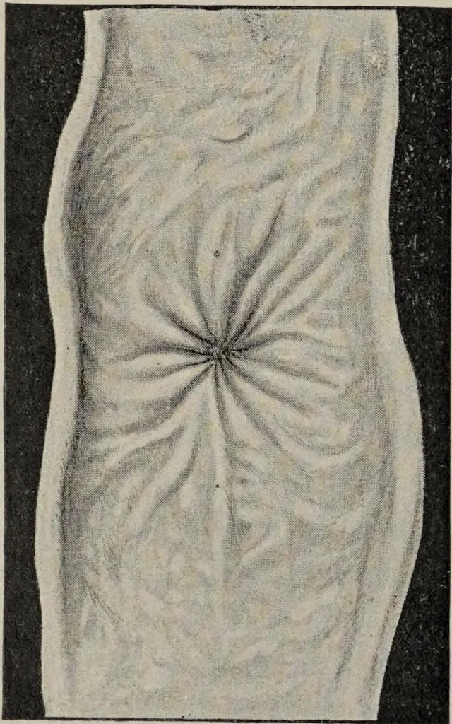 An illustration from A text-book of pathology / by Alfred Stengel ; with 394 illustrations in the text, many of them in colors, and 7 full-page chromolithographic plates., 1903, leaf 542