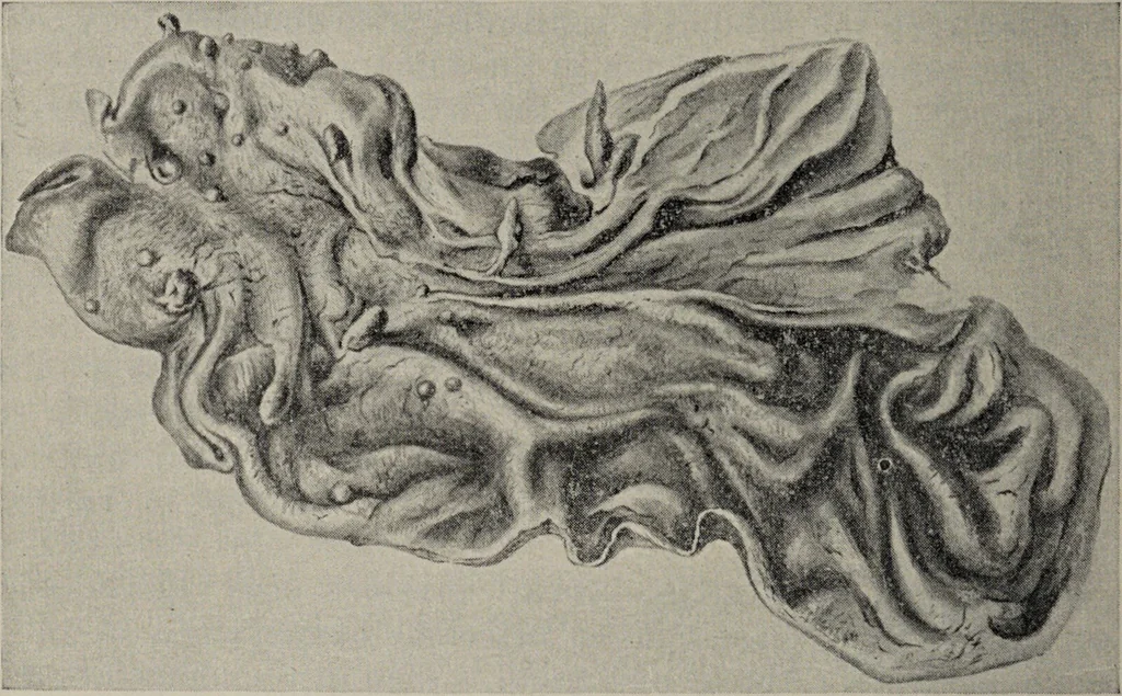 An illustration from A text-book of pathology / by Alfred Stengel ; with 394 illustrations in the text, many of them in colors, and 7 full-page chromolithographic plates., 1903, leaf 546
